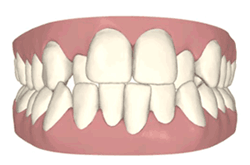 invisalign