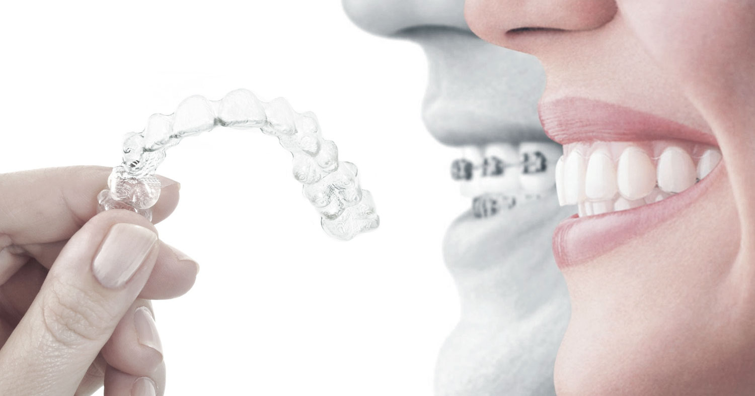 invisalign